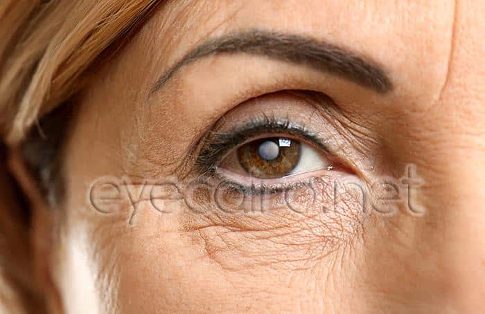 Cataract of the eye