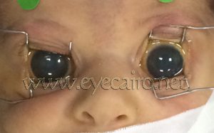 large cloudy eyes of congenital glaucoma