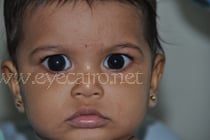 عينا الطفلة منى من اليمن بعد إجراء عمليات المياه الزرقاء الجلوكوما الخلقية لها بواسطة د أحمد خليل فى القاهرة مصر