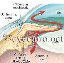 Closed angle glaucoma at Dr Khalil eye clinic in cairo egypt