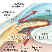 Open angle glaucoma at Dr Khalil eye clinic in cairo egypt