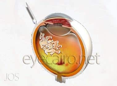 Injection of special medicines into the eye in cases of diabetes and age related macular degeneration at Dr Khalil eye clinic in cairo, Egypt