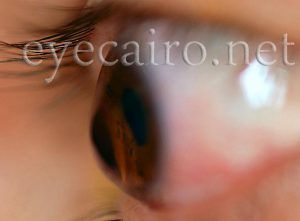 keratoconus treatment at best international standards at dr khalil eye clinic in Cairo, Egypt