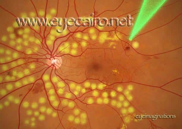 laser treatment of the retina at Dr Khalil Eye Clinic