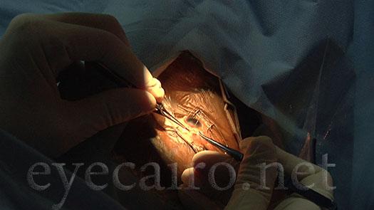 cataract-glaucoma-surgery-khalil-t-525x295