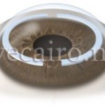 corneal rings for corneal ectasia and keratoconus