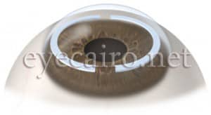 corneal rings for corneal ectasia and keratoconus