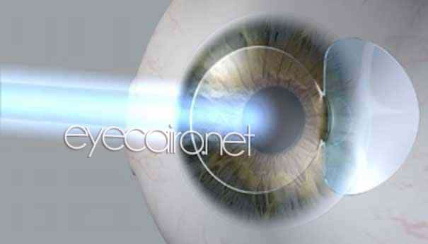 The excimer laser beam treats the cornea to improve the eyesight in lasik eye surgery with best and newest expertise and equipment at Dr Khalil Eye Clinic in Cairo., Egypt