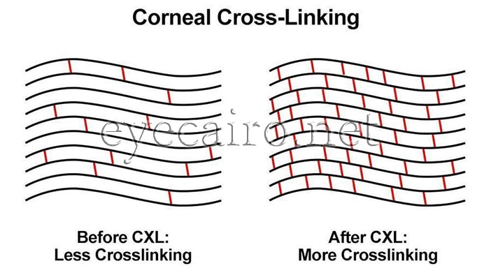 Colagen cross linking for Keratoconus