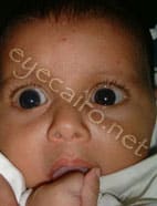 moderate congenital glaucoma treated at Dr Khalil eye clinic in cario