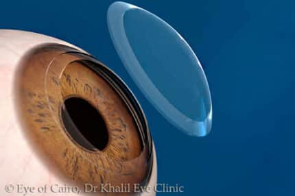 Keratoplasty at Dr Khalil Eye clinic, Cairo, Egypt