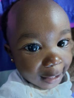 Martha from Nigeria had her congenital glaucoma surgery at Dr Khalil Eye Clinic in Cairo