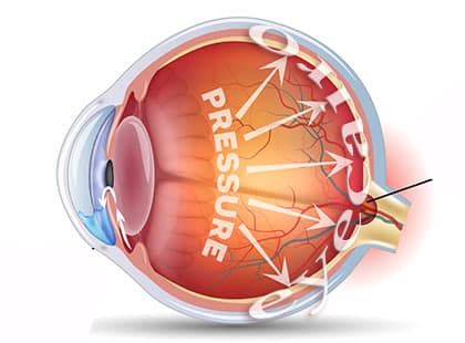 Glaucoma. Detailed anatomy of Glaucoma and healthy eye.