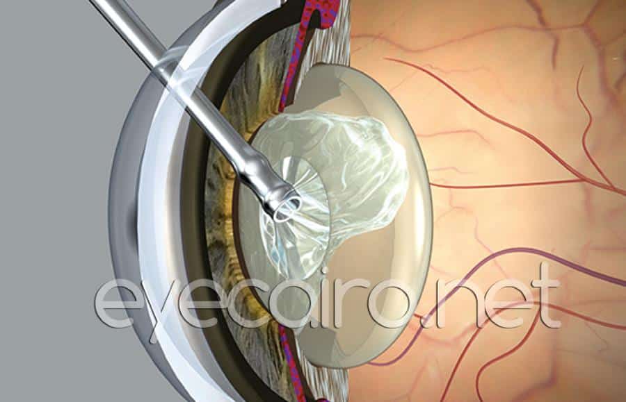 modern cataract surgery at dr khalil eye clinic in cairo