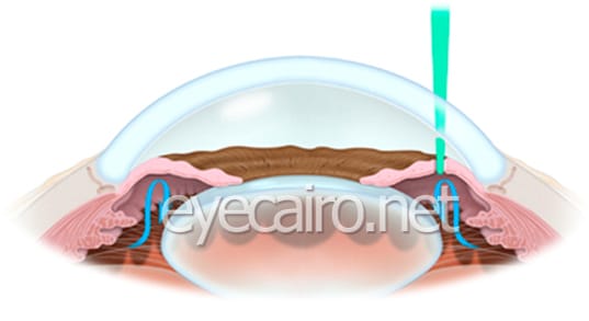 Treatment of Glaucoma by laser at dr khalil eye clinic in cairo, Egypt