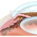 types of glaucoma, narrow angle