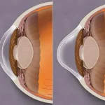 to the left is a section of the normal cornea, and to the right a cornea with keratoconus