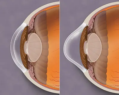 to the left is a section of the normal cornea, and to the right a cornea with keratoconus