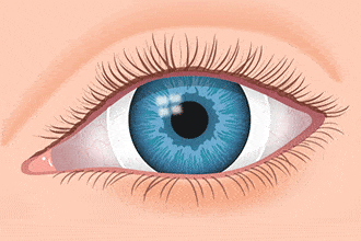 scleral RGP contact lenses for keratoconus at Dr Khalil Eye Clinic