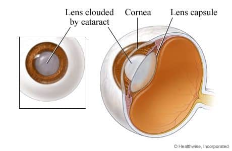 catarct of the eye and its treatment at Dr Khalil Eye Clinic in Cairo, Egypt