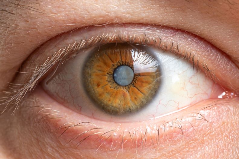 cataract of the eye