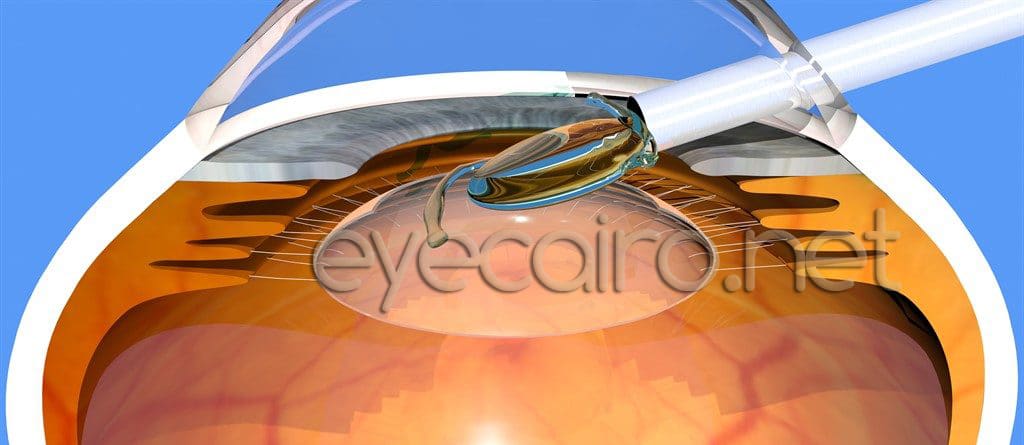 lens implantation during cataract surgery at Dr Ahmad Khalil eye clinic in Cairo, Egypt