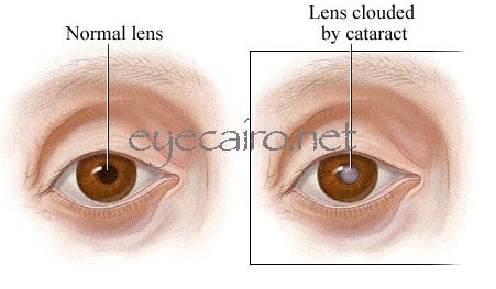 a front diagram of an eye cataract and a normal eye