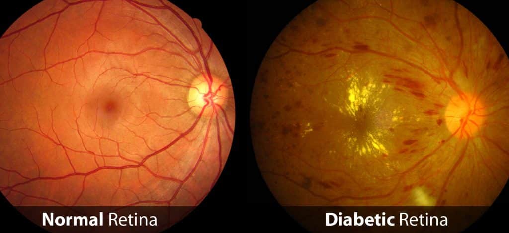 retina in diabetes, and treatment of diabetic retina
