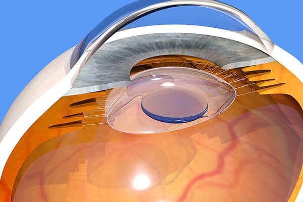 refractive lens exchange at Dr Khalil Eye clinic in Cairo