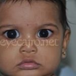 Glaucoma in children is treated by surgery