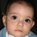 This child has been operated successfully for congenital glaucoma by Dr Khalil in 2003. She is being followed up ever-since with a favorable outcome.